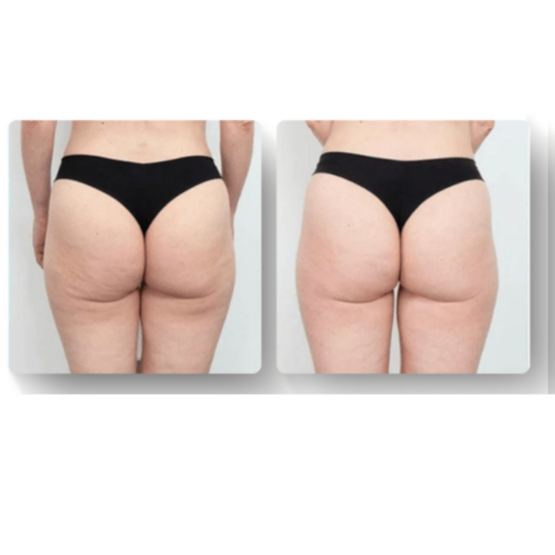 LuxeSilhouette Anticellulite Massager | Forbedr din hudplejerutine med en premium foryngende massager-zarada.dk