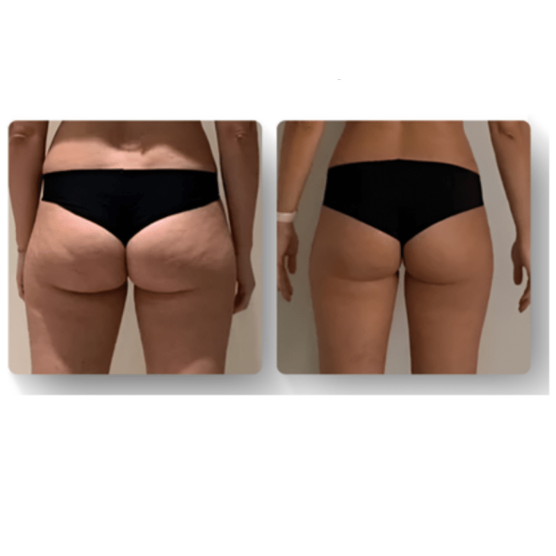 LuxeSilhouette Anticellulite Massager | Forbedr din hudplejerutine med en premium foryngende massager-zarada.dk