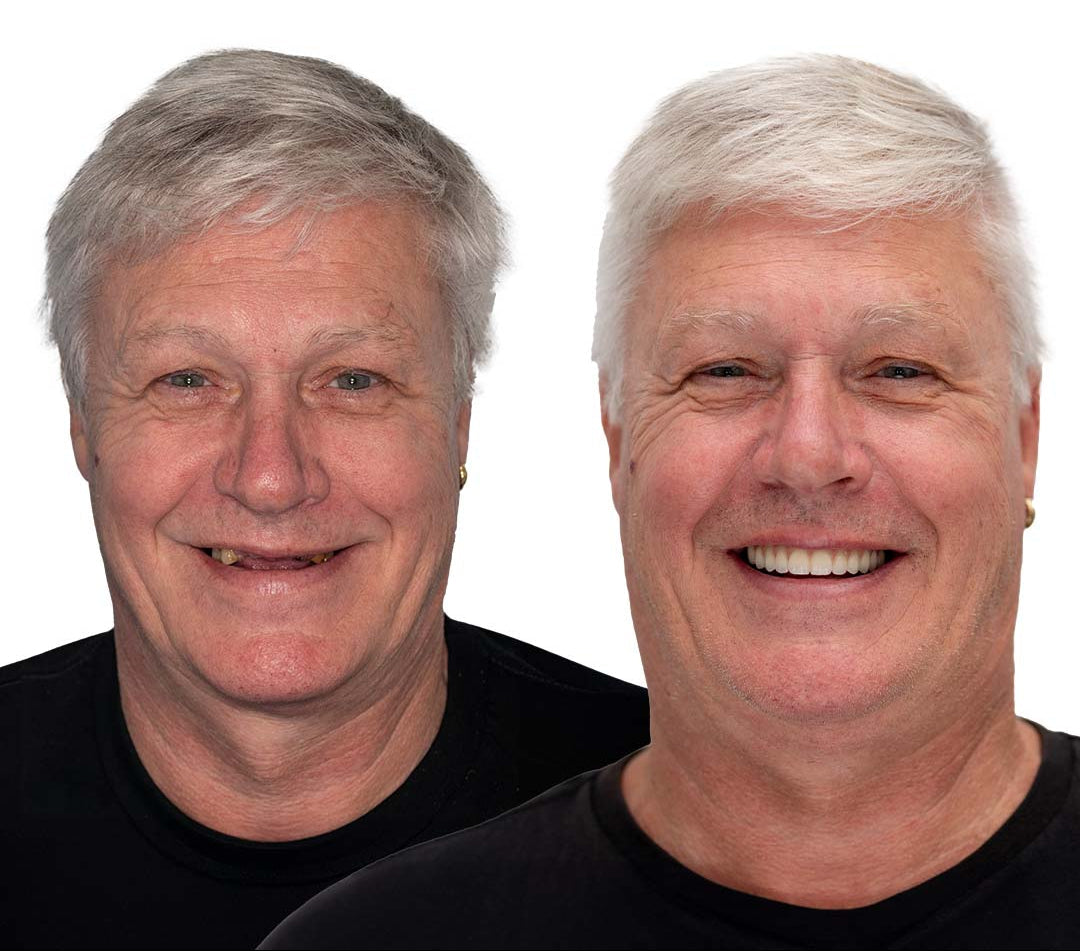 DentalKit - Naturligt udseende og følelse uden tandlægen!