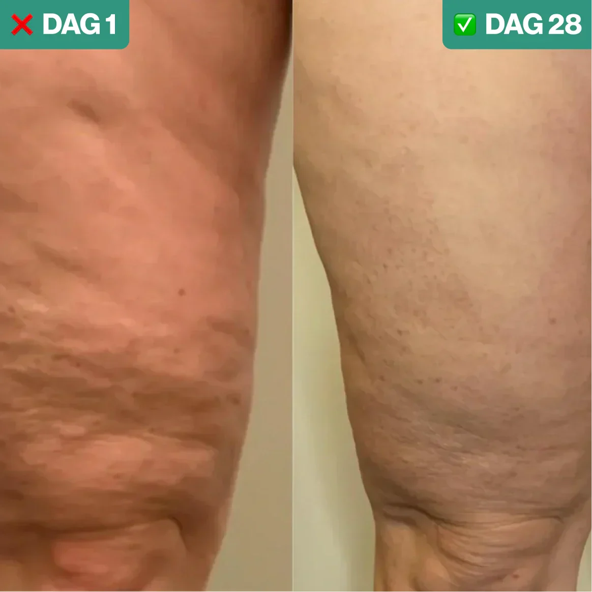 SmoothLift | Anti-Cellulite & Hudstramningsbehandling-zarada.dk