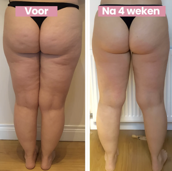 SmoothLift | Anti-Cellulite & Hudstramningsbehandling-zarada.dk