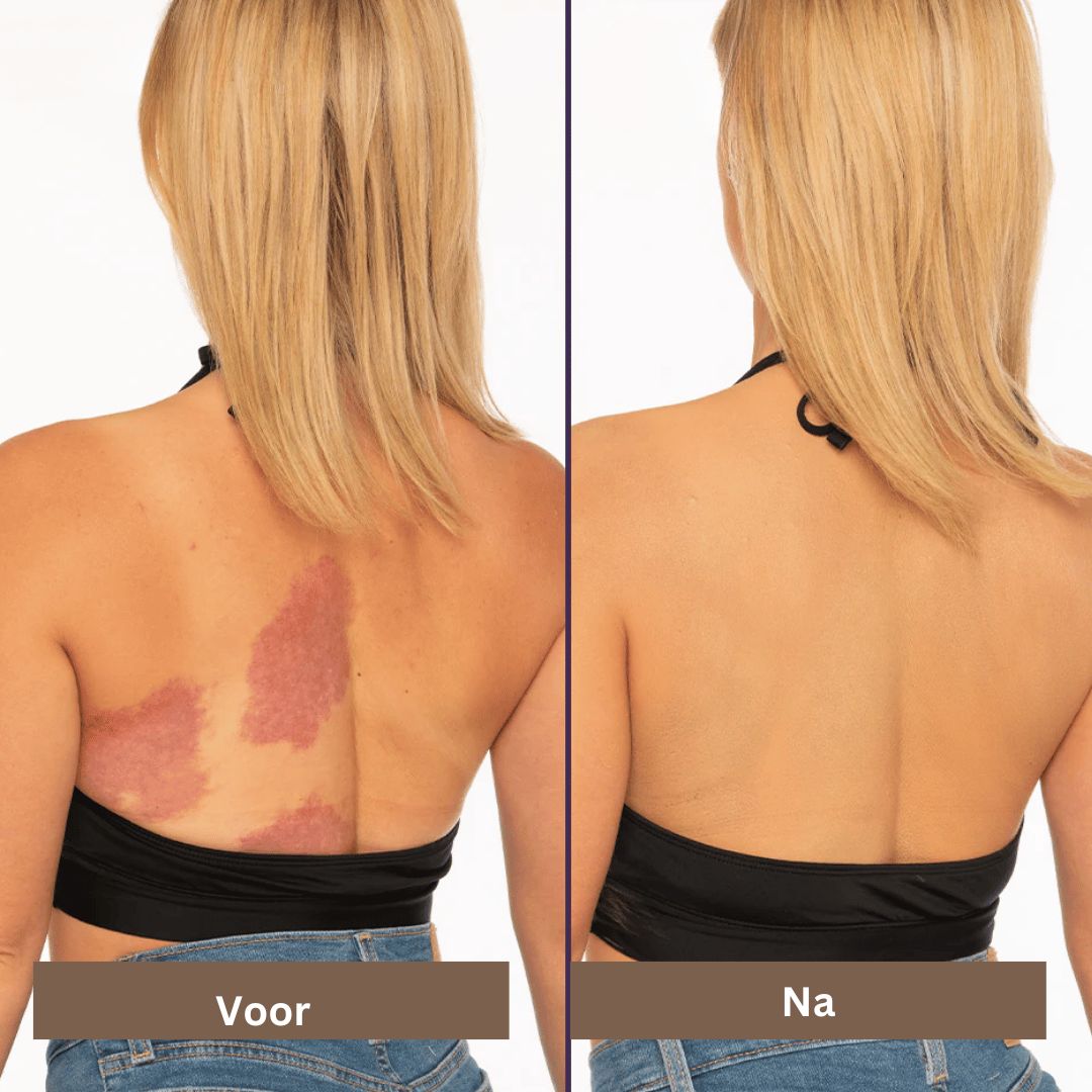 SmoothTone hudpleje | Til dækning af ar, årer, acne og solpletter-zarada.dk